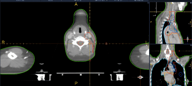 Case 1 — animated treatment visualization for breast cancer metastasis