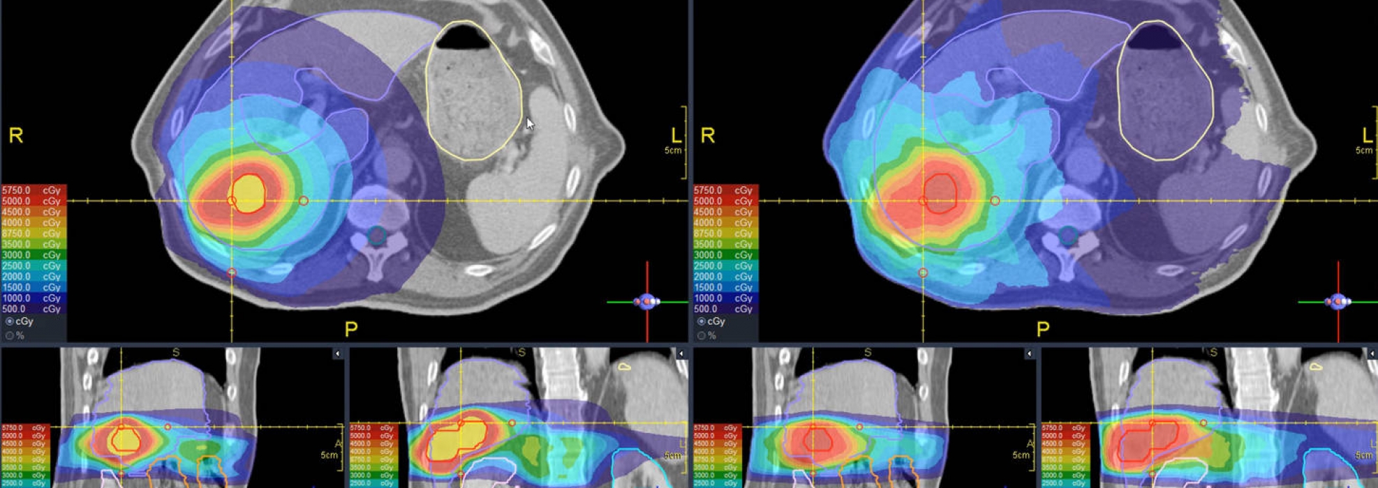 Case 2 liver cancer treatment planning — image 1 of 2