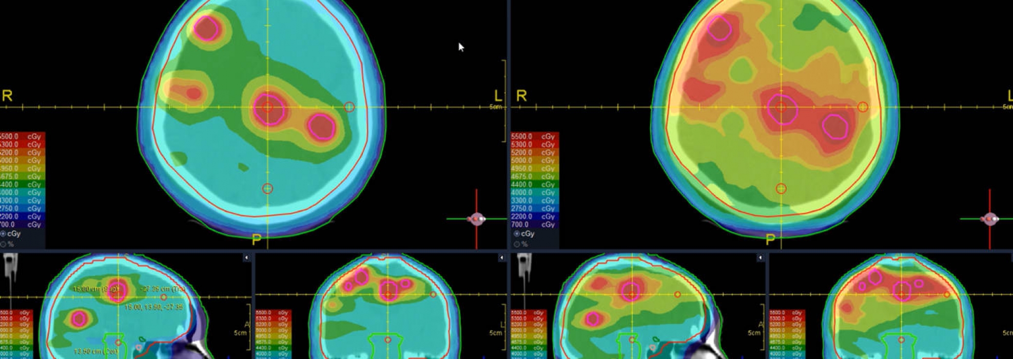 Case 3 brain metastasis treatment planning — image 1 of 2